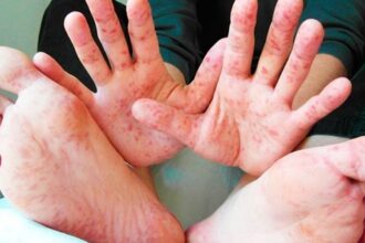 В Україні у 20 разів зросла кількість випадків захворювання на кір